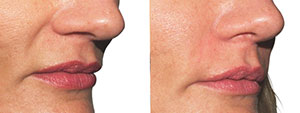 Fillers