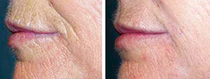 Fillers