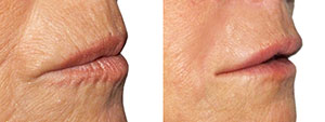 Fillers