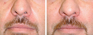 Fillers