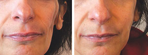 Fillers