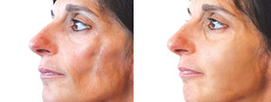 Fillers