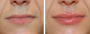 Fillers