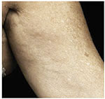 Thermage Body
