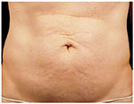 Thermage Body