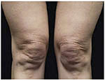 Thermage Body