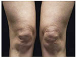 Thermage Body