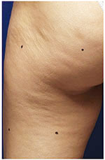 Thermage Body