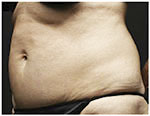 Thermage Body