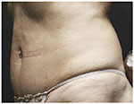 Thermage Body