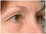 Thermage Eyes