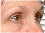 Thermage Eyes