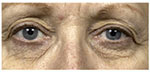 Thermage Eyes