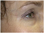 Thermage Eyes