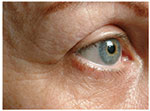 Thermage Eyes