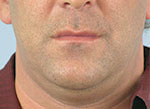Thermage Face