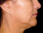 Thermage Face
