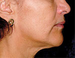 Thermage Face