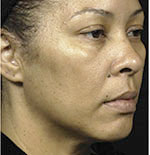 Thermage Face