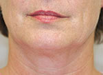 Thermage Face