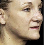 Thermage Face